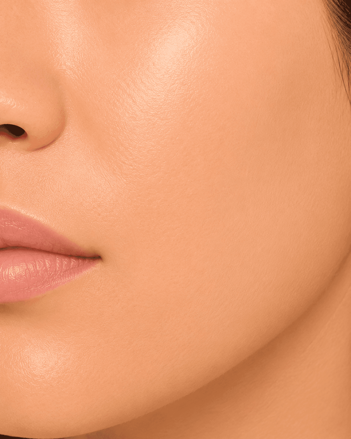Acne Scarring — after