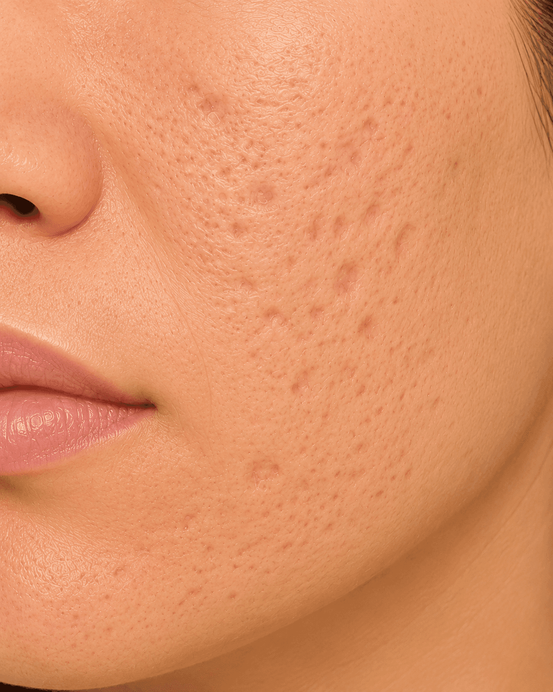 Acne Scarring — before