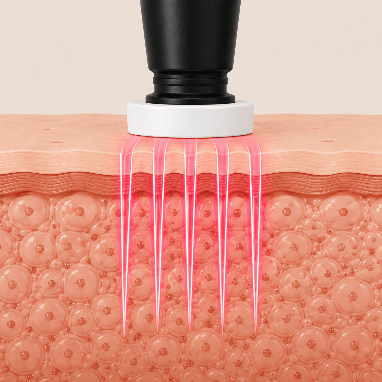 Illustrated demonstration of Procell Microchanneling step 2: The Procell Treatment