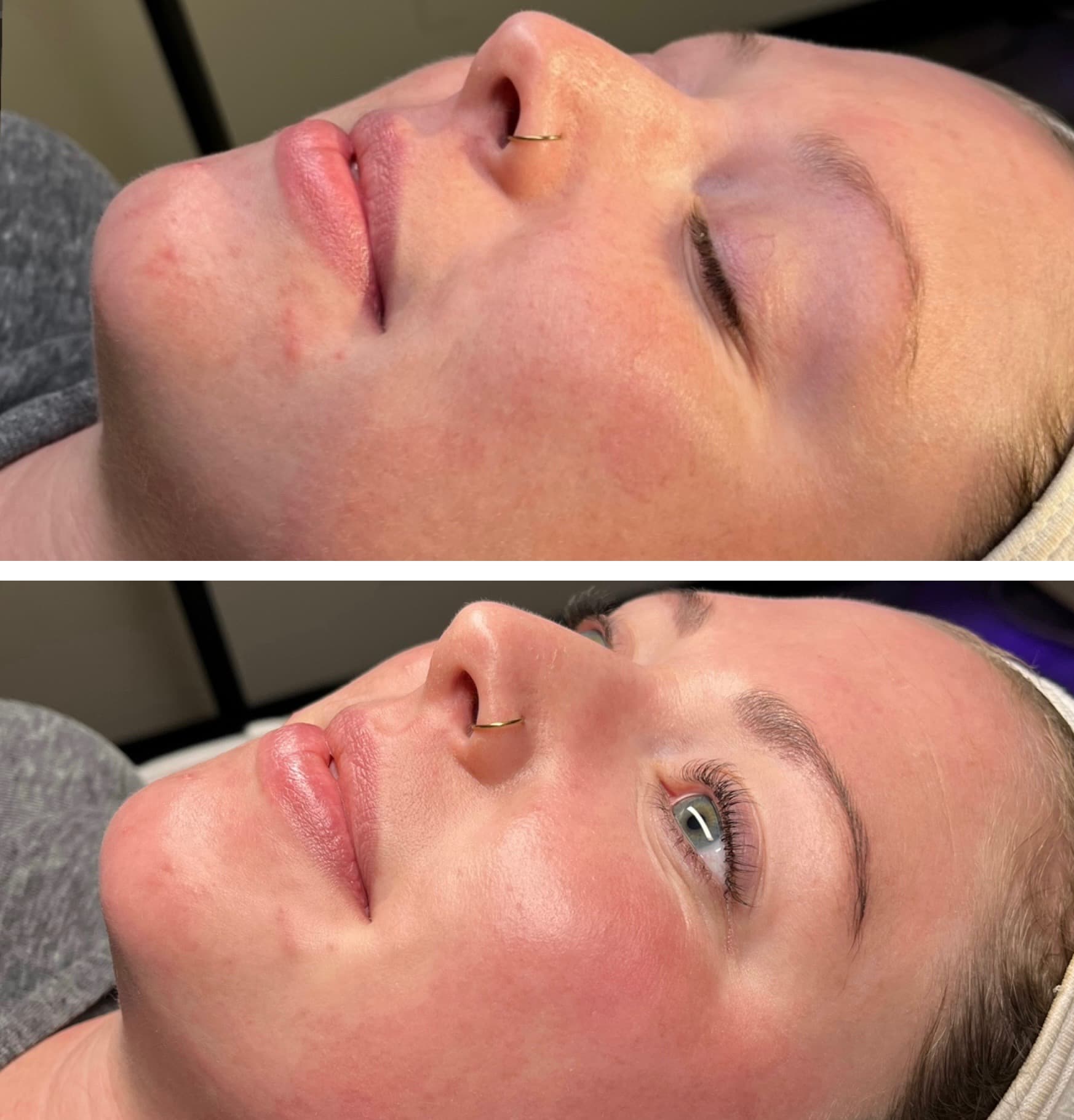 Real client showing skin texture and tone improvement after 1 HydraFacial session at Lovely Lilly's North Austin studio — top panel shows visible breakouts and redness, bottom panel shows clearer calmer skin