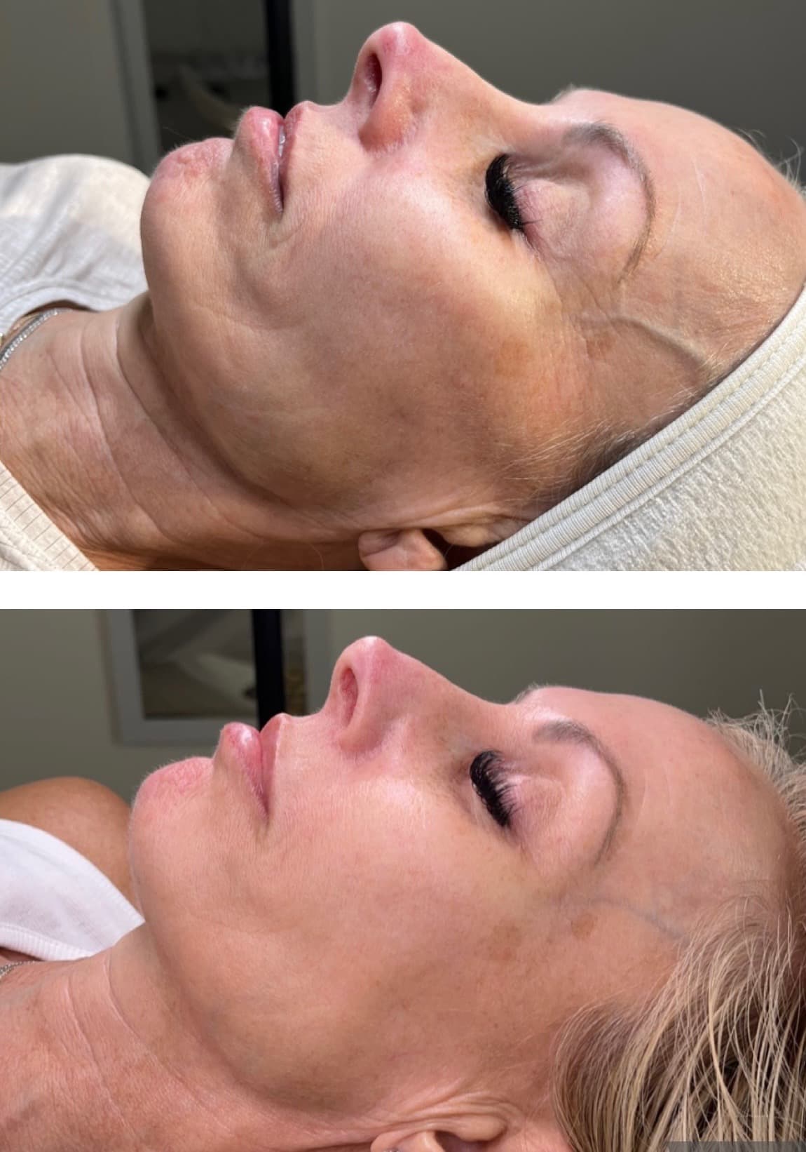Real client showing improved firmness and texture in mature skin after 3 Procell Microchanneling treatments at Lovely Lilly's